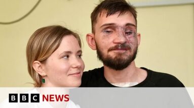 How Ukraine's war wounded repair their lives - BBC News