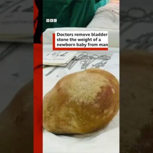 Doctors remove bladder stone the weight of a newborn baby from man. #SriLanka #BBCNews