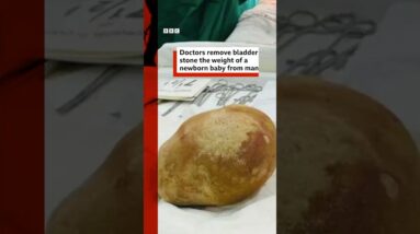 Doctors remove bladder stone the weight of a newborn baby from man. #SriLanka #BBCNews